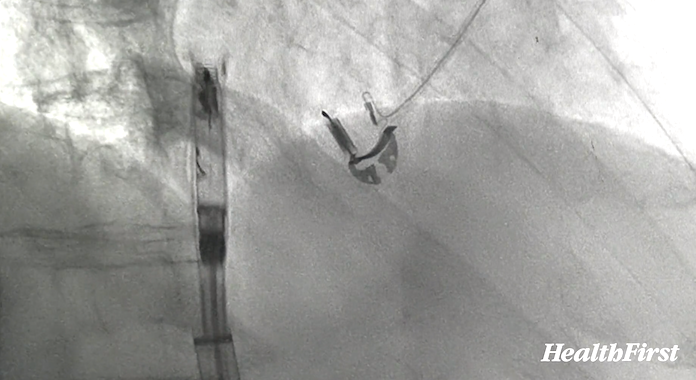 Avier Pacemaker